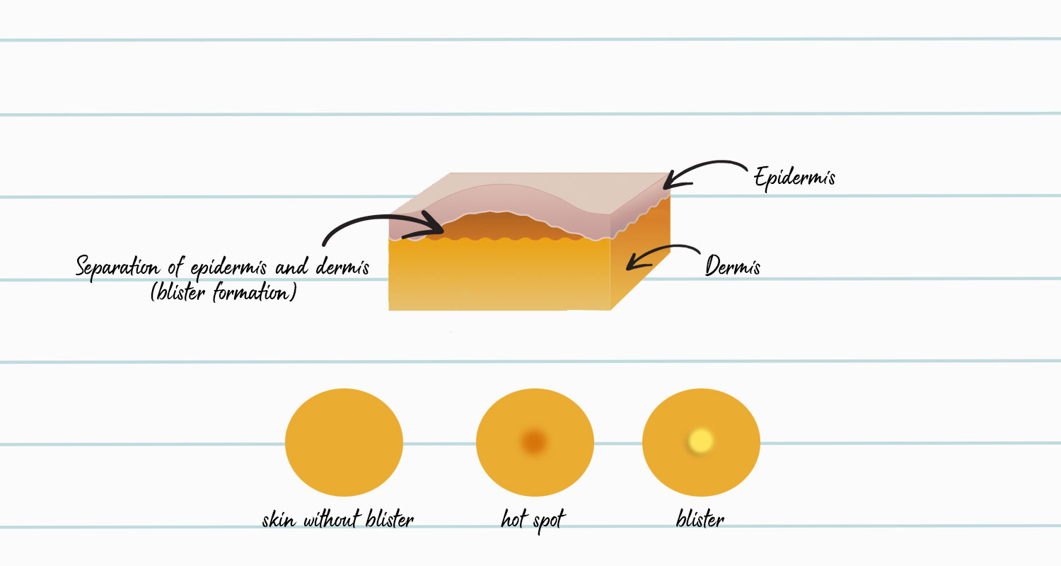 blister formation infographic